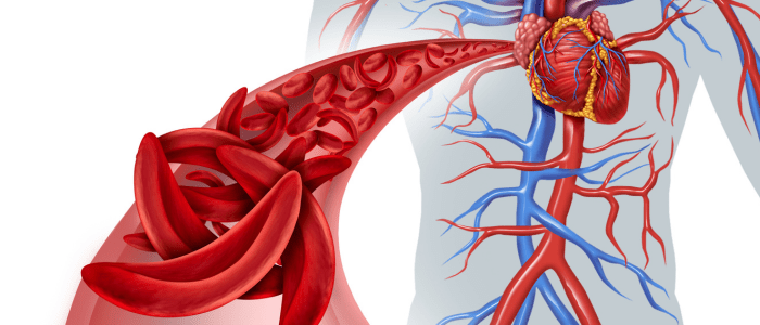 Sickle shaped red blood cells and normal red blood cells going through an artery towards the heart. To represent the concept that sickle cell disease is the initial target for novel cell and gene therapies.
