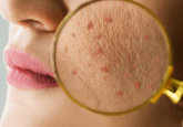 An close-up image of a woman's face. A magnifying glass is held up to her cheek, highlighting otherwise unseen red lumps. To represent crowdsourced real-world skin images create the SCIN dataset